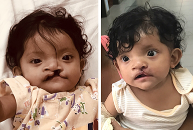 Cleft lip repair, Ecuador
