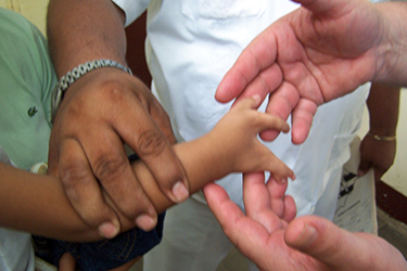 Hand malformation, Nicaragua