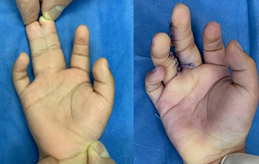 Syndactyly Case, before and after